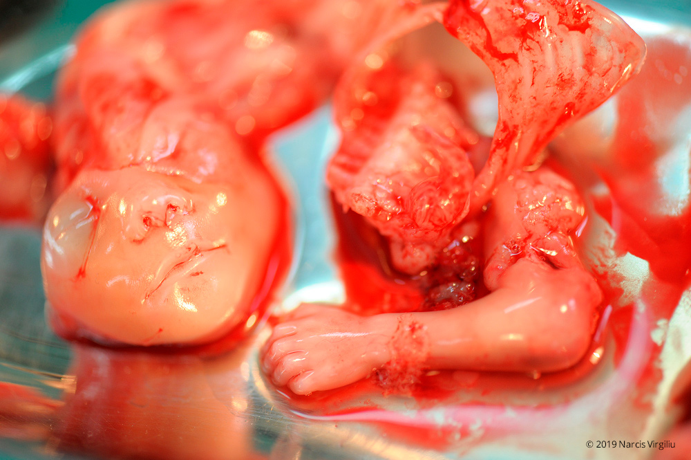 Abortion - 15 weeks 