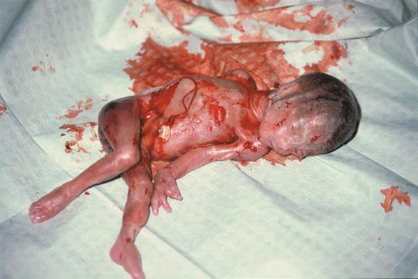 Abortion - 24 weeks